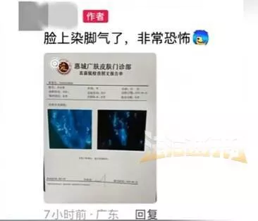 男子健身后脸上染"脚气"，直呼太恐怖！多人曾中招